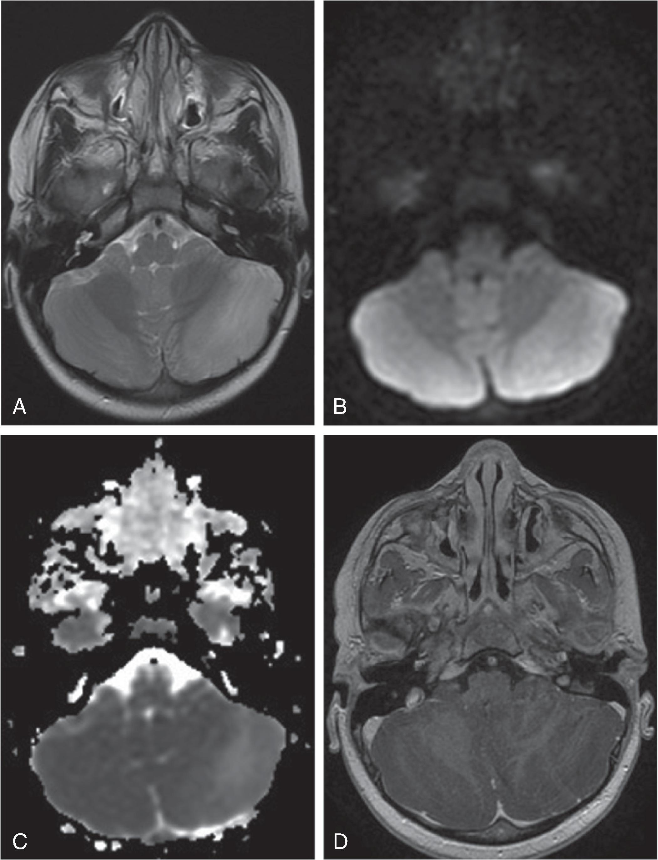 Fig. 6.20, Cerebellitis.