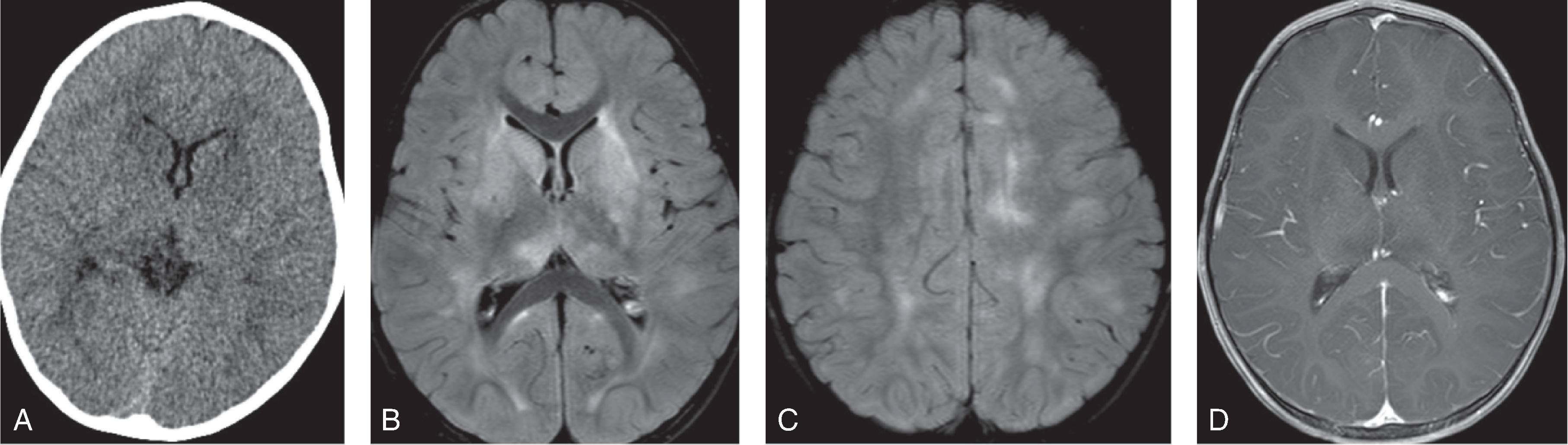 Fig. 6.2, Acute Disseminated Encephalomyelitis (ADEM).