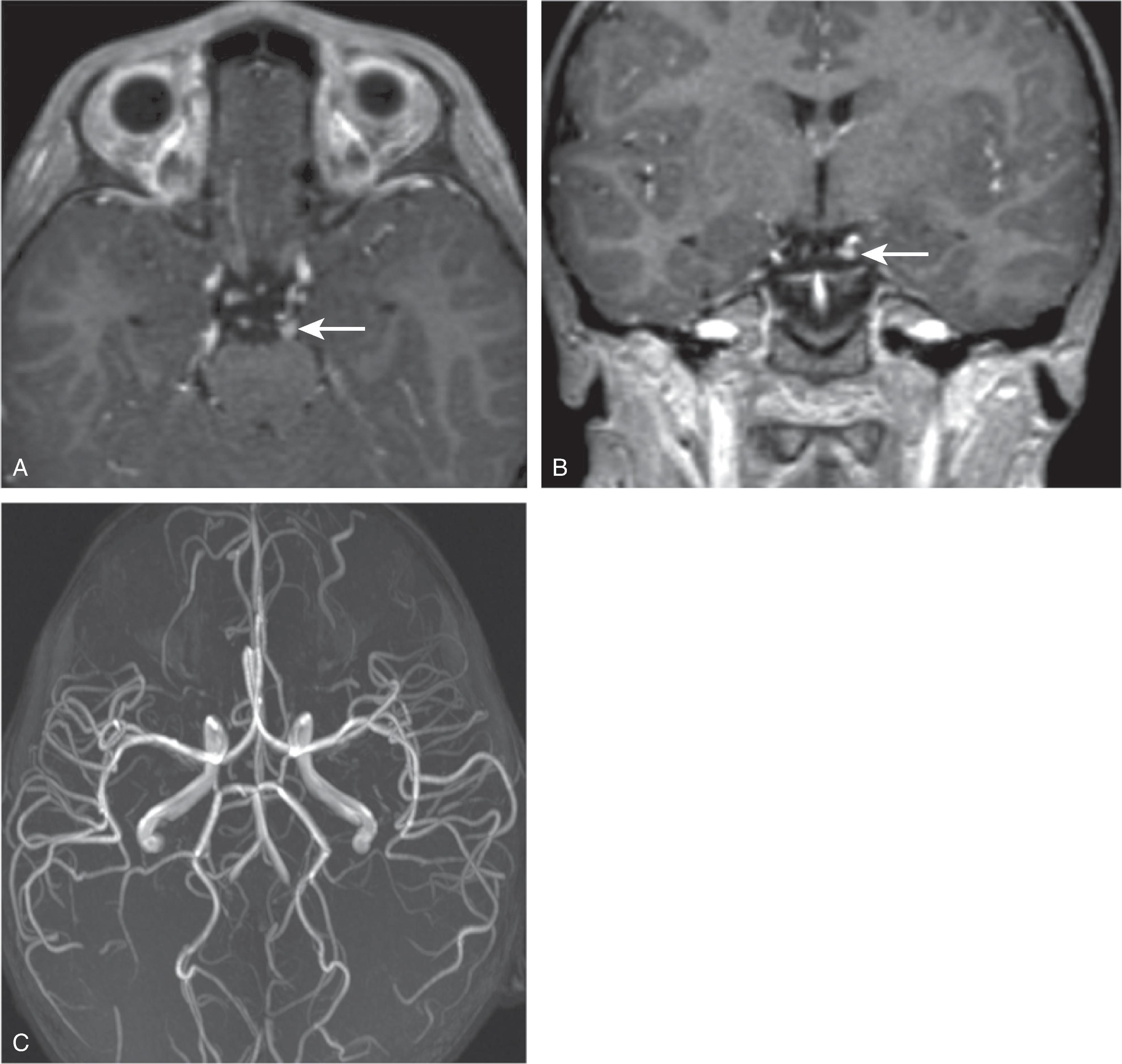 Fig. 6.22, Ophthalmoplegic Migraine.