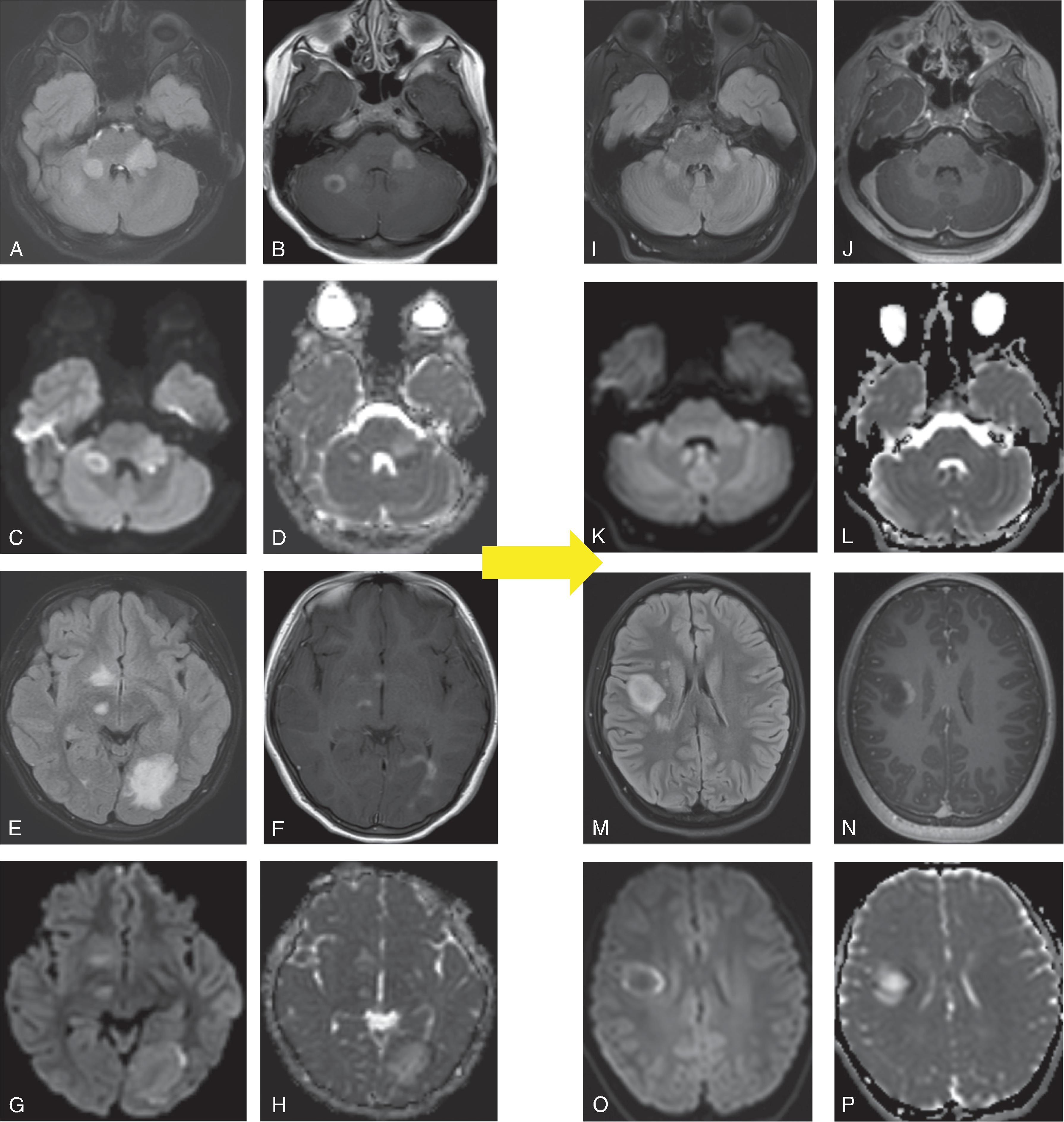 Fig. 6.3, Multiphasic Acute Disseminated Encephalomyelitis (ADEM).
