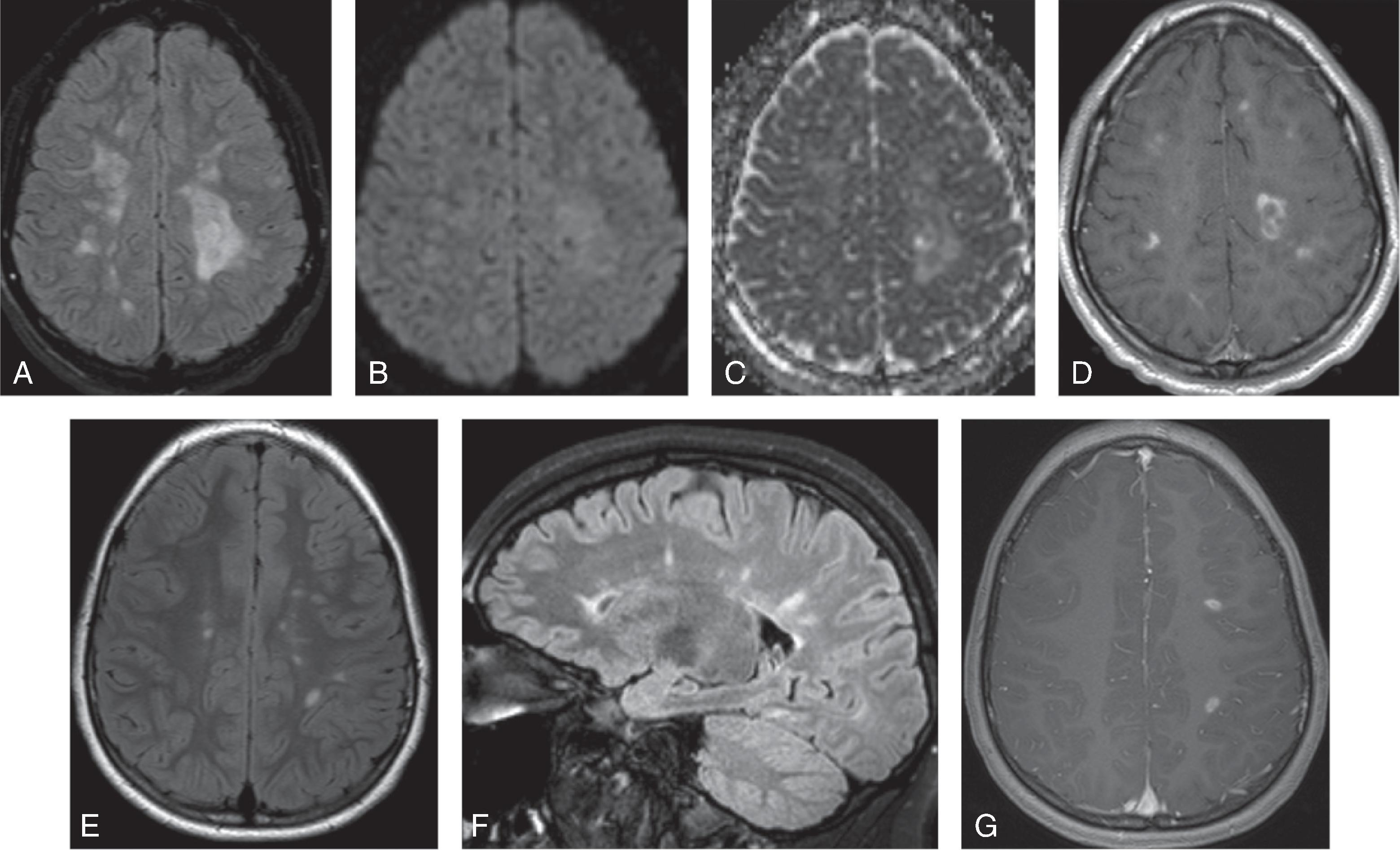 Fig. 6.4, Multiple Sclerosis.