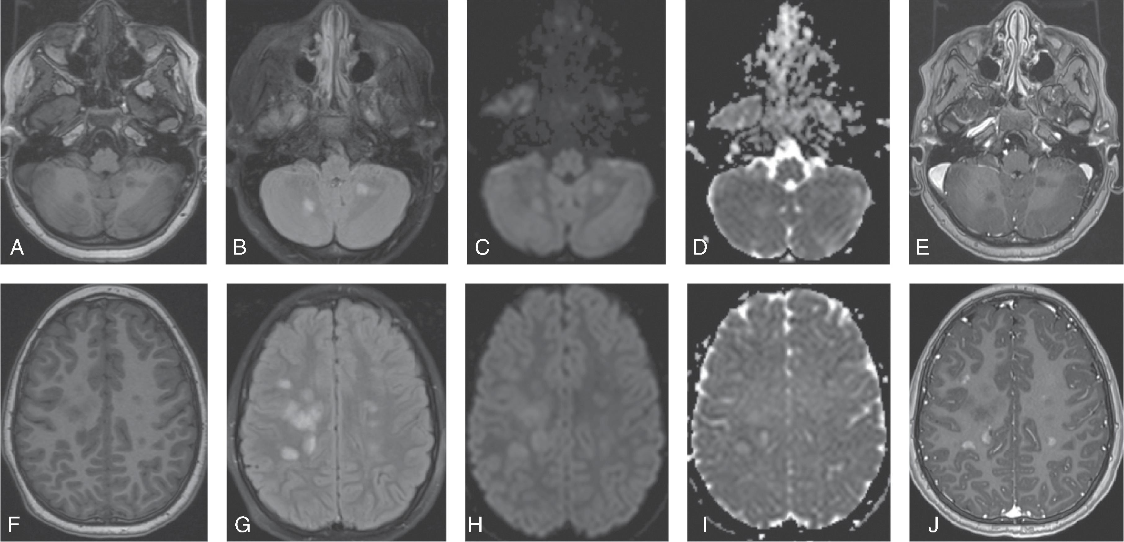 Fig. 6.5, Multiple Sclerosis.