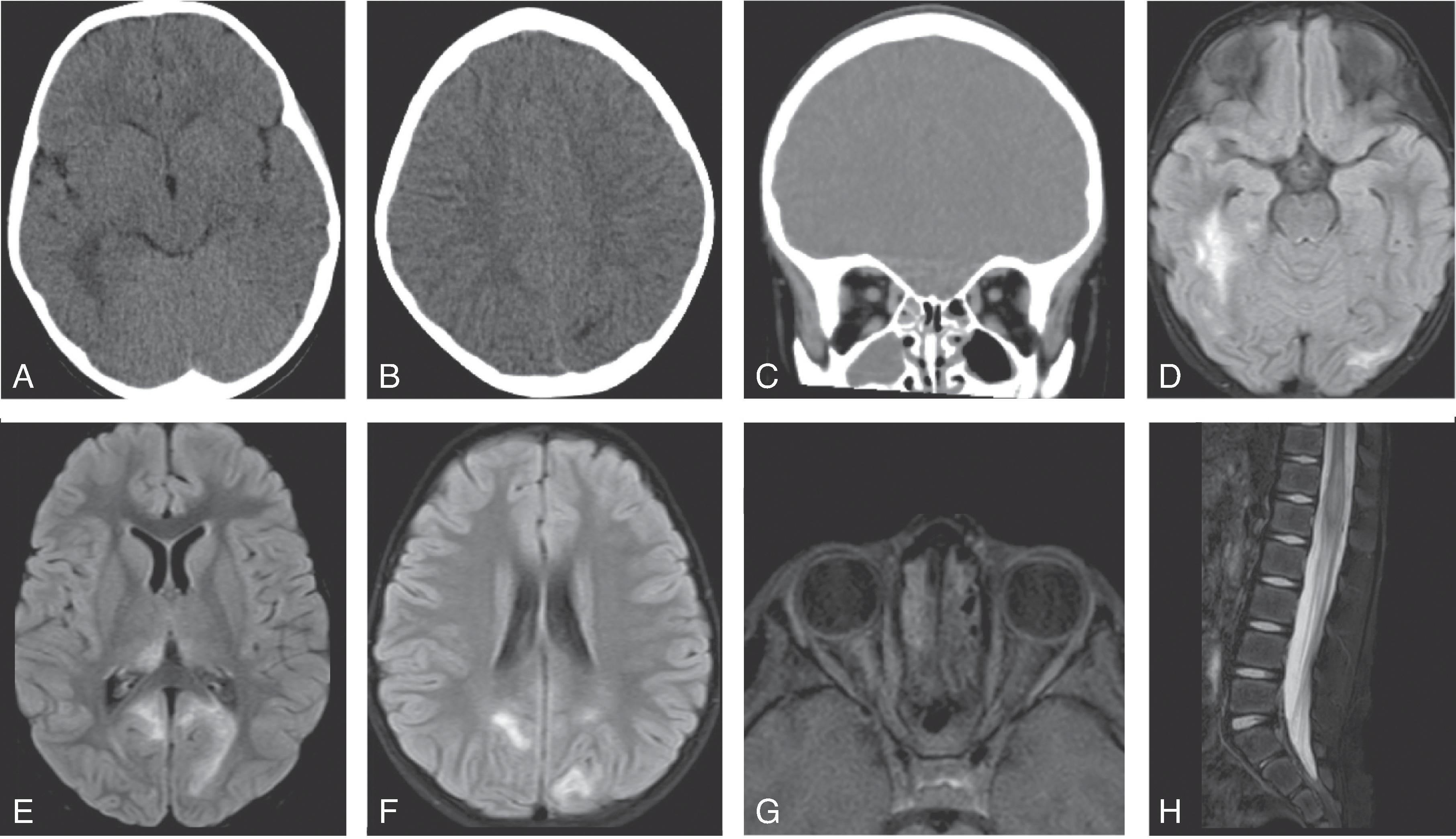 Fig. 6.6, Anti-MOG Demyelination.