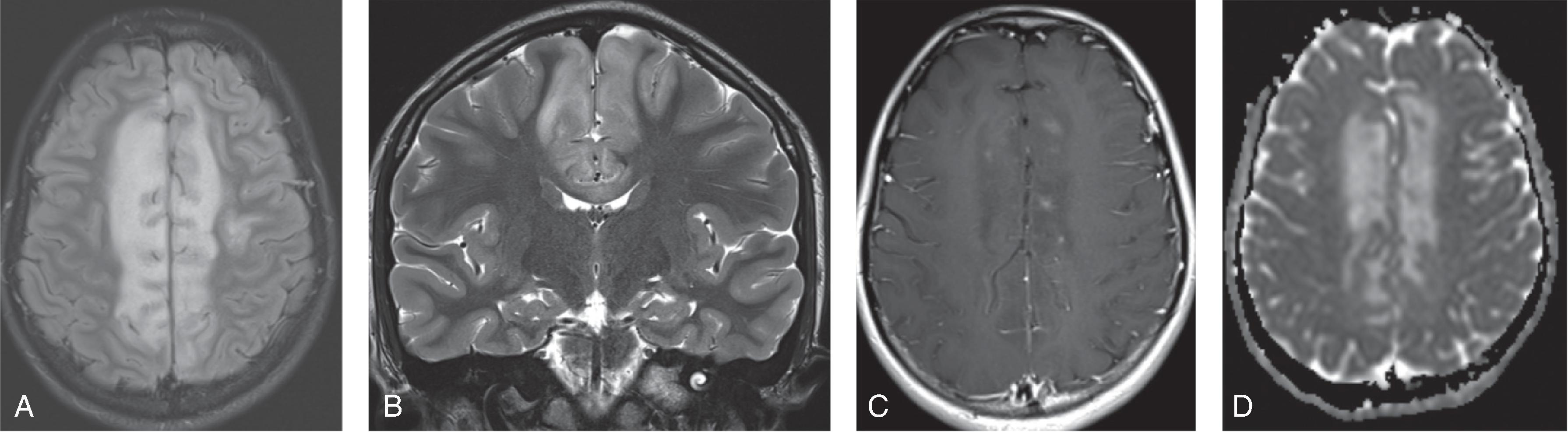 Fig. 6.8, Anti-MOG Demyelination.