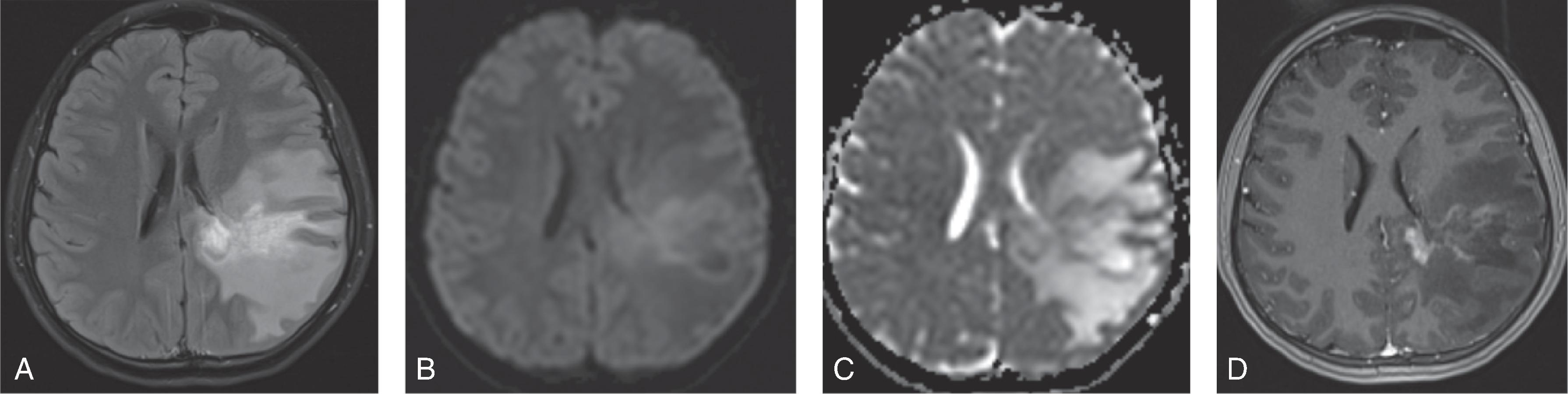 Fig. 6.9, Anti-MOG Demyelination.