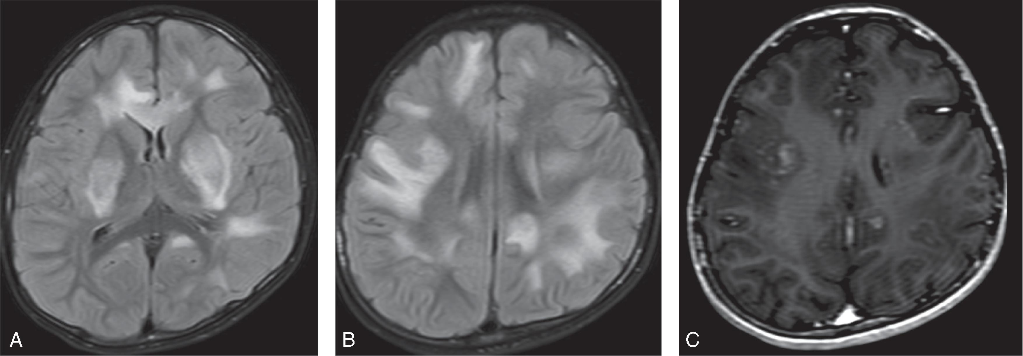 Fig. 6.10, Anti-MOG Demyelination.