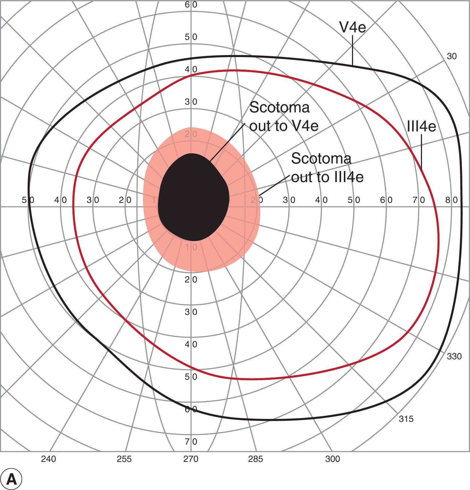 Fig. 56.2, Optic neuritis in a 16-year-old girl. Goldmann visual fields showing central scotoma right eye (A) and optic nerve edema right eye (B) in the setting of subacute vision loss to 20/80 right eye, dyschromatopsia, and a relative afferent pupillary defect right eye.