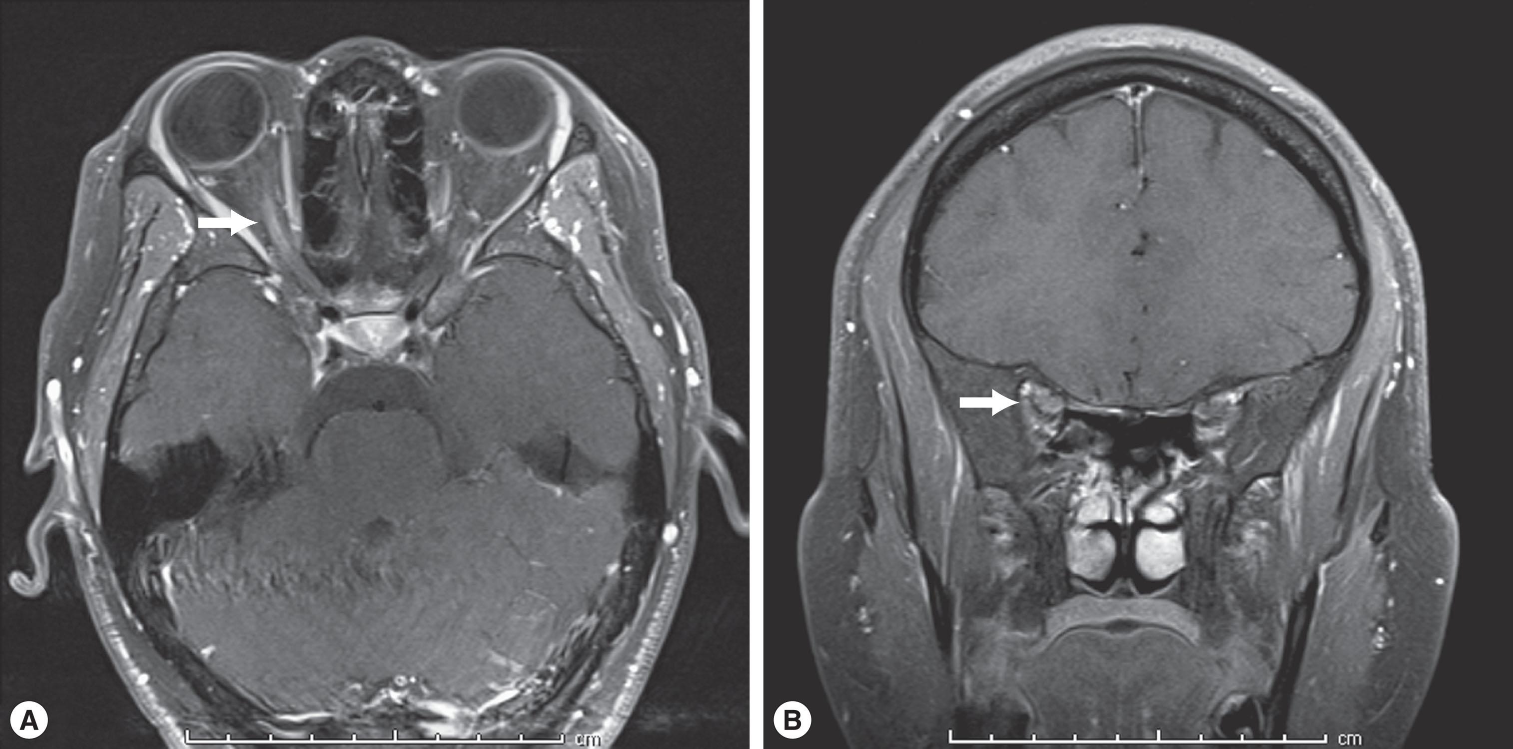 Fig. 56.3, MRI findings in unilateral optic neuritis. T1-weighted post gadolinium MRI axial (A) and coronal (B) images revealing contrast enhancement of the right optic nerve (arrows) in the patient in Fig. 56.2 .