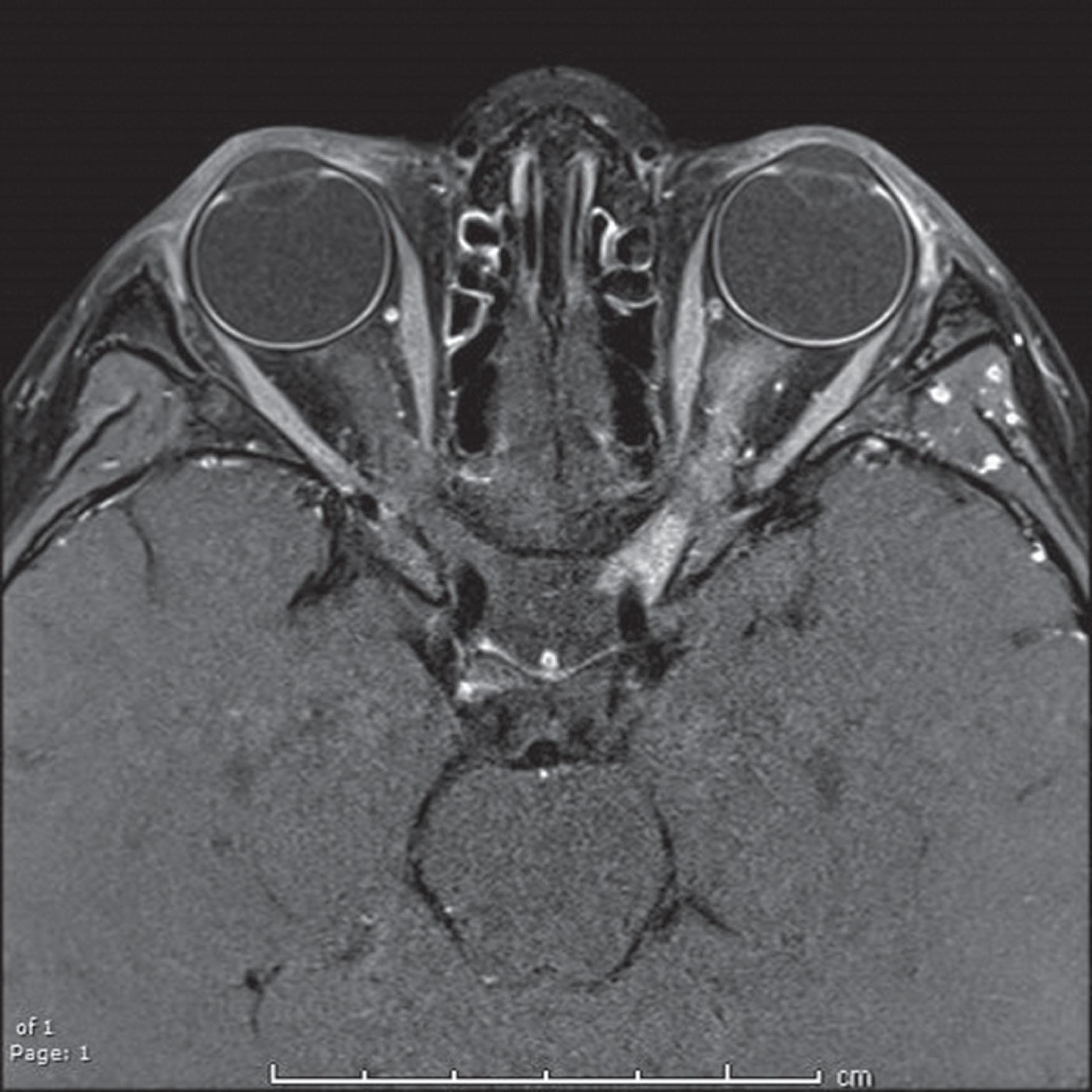 Fig. 56.5, MRI findings in MOG-IgG+ optic neuritis. T1-weighted post gadolinium MRI axial image revealing extensive longitudinal enhancement of the left optic nerve in a 6-year-old girl with light perception vision.