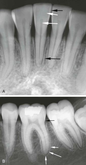 eFIGURE 115-1, A , This intraoral periapical projection of the mandibular incisors reveals enamel layer (short black arrow), dentine layer (short white arrow), pulp chamber (long white arrow), and lamina dura (long black arrow) . B , This intraoral periapical projection of the mandibular molars reveals the cementoenamel junction (black arrow), the radiopaque lamina dura (short white arrow), the radiolucent periodontal ligament space (long white arrow), and the periapical region (medium white arrow).
