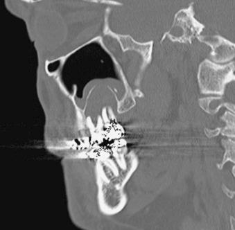 eFIGURE 115-11, Reformatted sagittal CT image (bone algorithm) of a radicular cyst invaginating sinus and associated with a maxillary molar. Note the cortex between the cyst and internal aspect of the sinus.