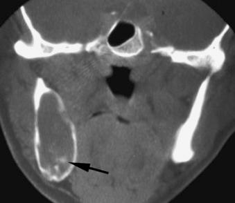 eFIGURE 115-12, Coronal CT image (bone algorithm) of a long-standing cyst with internal dystrophic calcification (arrow).