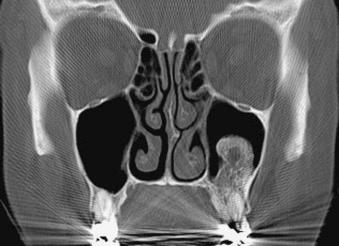 eFIGURE 115-13, Coronal CT image (bone algorithm) of a long-standing and collapsing radicular cyst. New bone has formed from the periphery, leaving a residual radiolucent center.