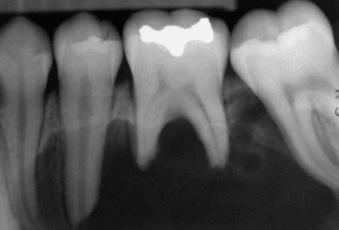 eFIGURE 115-14, Periapical radiograph of a radicular cyst involving the first mandibular molar with extensive root resorption and displacement of the second molar.