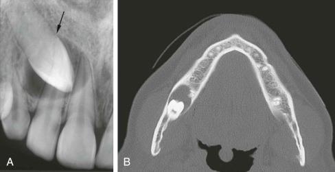 eFIGURE 115-15, A , Periapical radiograph with a small dentigerous cyst associated with an impacted cuspid. The cyst attaches to the cemental enamel junction (arrow) . B , Axial CT image (bone algorithm) of a small dentigerous cyst in the pericoronal position related to an impacted third molar.