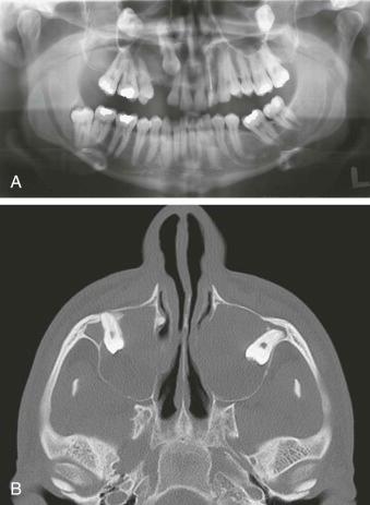 eFIGURE 115-16, A , Panoramic radiograph of a patient with three follicular cysts involving both third molars and the right maxillary cuspid. B , Axial CT image (bone algorithm) demonstrating that the two cysts involving the third molars occupy the majority of both maxillary antra and the teeth have been displaced into the zygomatic recess.