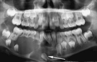 eFIGURE 115-17, This cropped panoramic radiograph reveals a large follicular cyst associated with the right cuspid that has been displaced to the inferior cortex of the mandible (arrow). The cyst has displaced both right bicuspids in a posterior direction and resorbed the roots of the deciduous teeth.