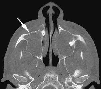 eFIGURE 115-18, This axial CT image (bone algorithm) depicts two large dentigerous cysts occupying both maxillary antra. Shown is the double cortical line (arrow); the outside line represents the anterior sinus wall, and the inside line represents the border of the cyst.