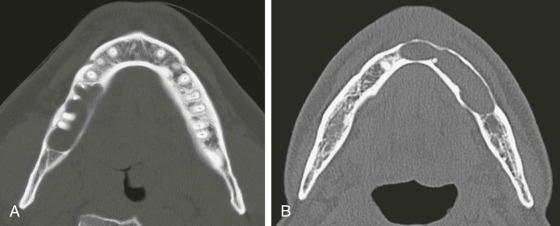 eFIGURE 115-19, A , Axial CT image (bone algorithm) of an odontogenic keratocyst demonstrating scalloping between the roots of the teeth. B , Axial CT image (bone algorithm) of an odontogenic keratocyst showing broad scalloping of the endosteal surface of the outer cortex.