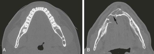eFIGURE 115-20, A , Axial CT image (bone algorithm) of an odontogenic keratocyst with curved septa between three loculations. B , Axial CT image (bone algorithm) of an odontogenic keratocyst with multiple septa. There is a rare straight septa (arrow).