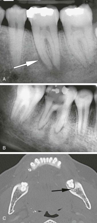 eFIGURE 115-2, A , This periapical radiograph depicts bone destruction (periapical rarefying osteitis) centered at the periapical region of the tooth. One can see the widening of the periodontal ligament space (arrow) that involves the apical section of the root. B , This periapical radiograph depicts a periapical inflammatory lesion. One can see the widening of the periodontal ligament space. Because there is a dominant sclerotic bone reaction, this may be termed periapical sclerosing osteitis . C , This axial CT image using a bone algorithm demonstrates a periapical inflammatory lesion related to the mandibular third molar (arrow).