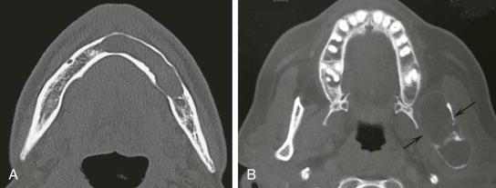 eFIGURE 115-21, A , Axial CT image (bone algorithm) of an odontogenic keratocyst. Shown is the tendency to grow along the bone with minimum expansion. B , In this example, the odontogenic keratocyst has caused a considerable amount of expansion of the mandibular ramus.