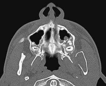 eFIGURE 115-22, This axial CT image shows perforation of a portion of the medial cortex.