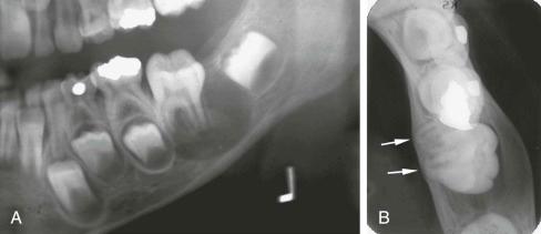 eFIGURE 115-24, A , Cropped panoramic radiograph of a buccal bifurcation cyst associated with the first molar. There is tipping of the molar so that the occlusal surface is profiled, unlike the other molars. B , An occlusal image of the same cyst showing tipping of the roots of the molar into the medial cortical plate of the mandible (arrows).