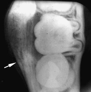 eFIGURE 115-25, Buccal bifurcation cyst. An occlusal radiograph demonstrating periosteal reaction (arrow) with no evidence of a cyst, but the roots of the first molar are displaced into the medial cortex.