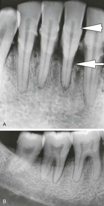 eFIGURE 115-3, A , This intraoral periapical radiograph shows bone destruction around the mandibular incisors from periodontal disease. The amount of bone loss is shown between the two arrows . B , This periapical radiograph shows bone loss around the mandibular molar regions from periodontal disease. There is bone loss in the furcation (between the roots) region of the molars.