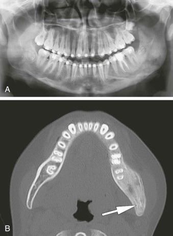 eFIGURE 115-4, A , Panoramic radiograph of osteomyelitis involving the left mandible. B , An axial CT image (bone algorithm) of the same patient as in A . Shown are remnants of the original medial cortical plate (arrow).