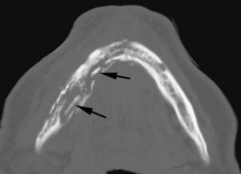 eFIGURE 115-5, Axial CT bone algorithm image of osteomyelitis of the mandible displaying sequestra (arrows).