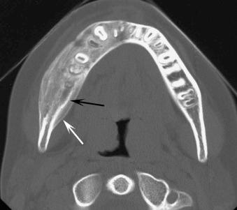 eFIGURE 115-6, Axial CT bone algorithm image of osteomyelitis. There is periosteal new bone formation (white arrow) and the residual original cortex (black arrow).