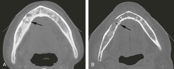 eFIGURE 115-8, A , Axial CT image of the body of the mandible involved with osteoradionecrosis. The predominant sclerotic reaction and the sequestra (arrow) are shown. B , Axial CT of another case of osteoradionecrosis, revealing mainly osteolytic changes. Shown is the loss of a portion of the lateral cortical plate, and a section of the medial cortical plate is now a sequestrum (arrow).