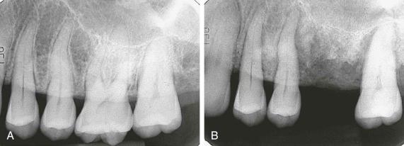 eFIGURE 115-9, A , Periapical radiograph of the maxillary dentition before the application of therapeutic radiation. B , Periapical radiograph of the same region 6 months after therapeutic radiation exposure. Widening of the periodontal ligament space, bone loss similar to periodontal disease, and sclerotic bone reaction can be seen.