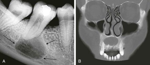 eFIGURE 115-10, A , Periapical radiograph of a radicular cyst associated with a mandibular molar. The well-defined cortical boundary can be seen. B , Coronal CT image (bone algorithm) of a radicular cyst associated with a maxillary incisor tooth.