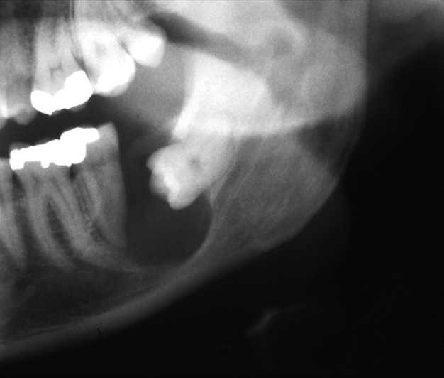 Part of a panoramic XR of a dentigerous cyst arising on a lower left wisdom tooth, which is unerupted and lying horizontally. It appears as a well-defined, circular radiolucency attached to the tooth at its neck. The inferior alveolar canal has been displaced inferiorly. *