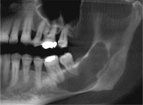 Part of a panoramic-style MPR on CBCT of an odontogenic keratocyst which appears as an elongated, loculated radiolucency extending from the mandibular foramen to the lower first molar region. There is thinning of the bony cortices but no jaw expansion, a feature associated with odontogenic keratocysts. **