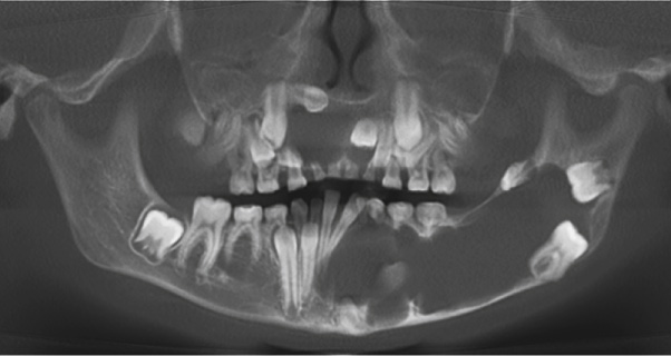 Panoramic-style MPR on CBCT showing odontogenic keratocysts in the left mandible and anterior maxilla consistent with Gorlin–Goltz syndrome. There is marked displacement of teeth by the cysts, which show minimal expansion. **