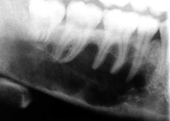 Part of a panoramic XR showing a partially corticated radiolucency in the right mandible involving the apices of the 2 nd premolar and 1 st and 2 nd molars diagnosed as a solitary bone cyst. Note the characteristic scalloping between the roots of the molars. *