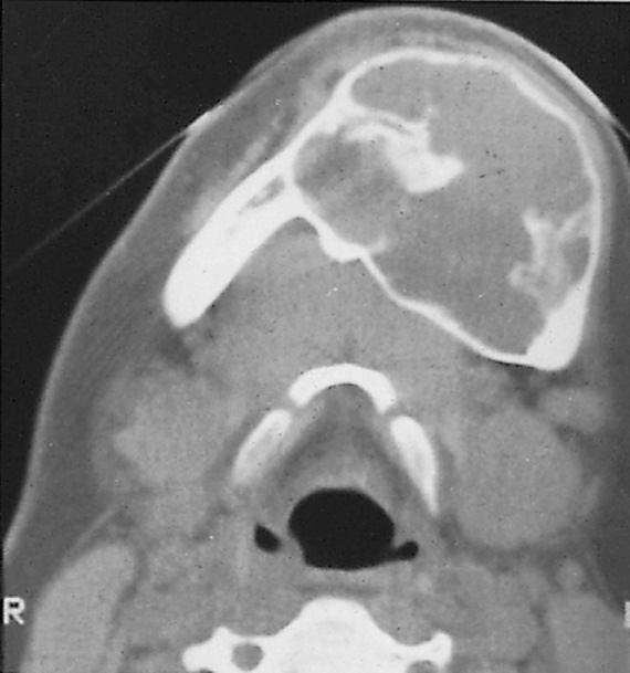Fibrous dysplasia and resulting degeneration into aneurysmal bone cyst. CT shows the expanded mandible and the now essentially cystic nature of the lesion. †