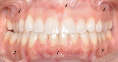 Fig. 1.18.4, Healthy dentition and gingiva with border of mucogingival junction ( arrows ) between keratinized (attached) tissue closest to teeth and loose alveolar mucosa extending into the vestibule.