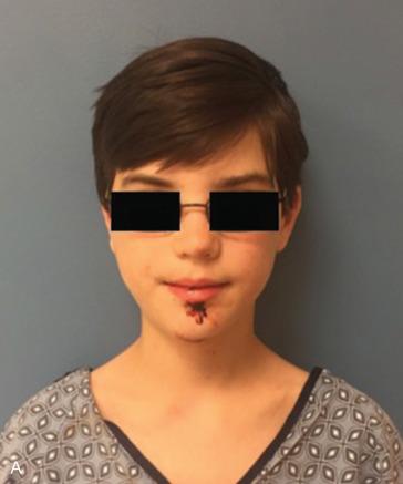 Fig. 1.18.5, Clinical photography. Standard frontal (A), lateral (B), submental (C), and intraoral (D – right lateral, E – frontal, F – left lateral) photographs are obtained for every patient with maxillofacial trauma. These photographs serve to aid in treatment planning, and documentation for medicolegal purposes as well as for patient education. We suggest using a standardized background (blue), and taking intraoral photographs in the patient's maximal intercuspation position (MIP) if possible. These photos demonstrate a full-thickness lip laceration as well as an intrusion injury of the permanent maxillary left lateral incisor.