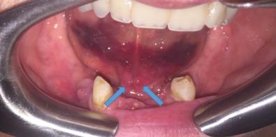 Fig. 1.18.6, A 66-year-old patient 5 days following a traumatic mandibular symphyseal fracture with resulting large floor of mouth hematoma and edema. Also visible are the bilateral submandibular (Wharton's) ducts ( arrows ).