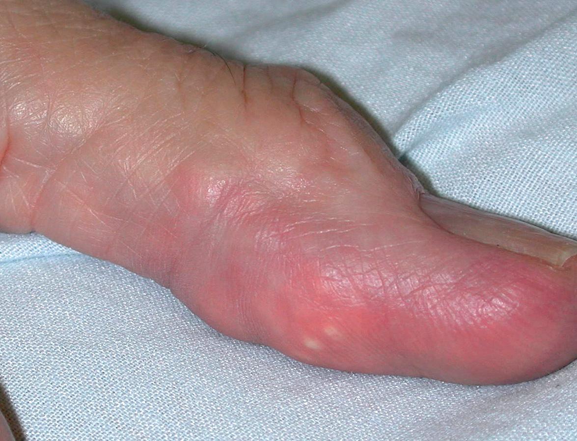 Fig. 48.1, Tophaceous gout of a digit.