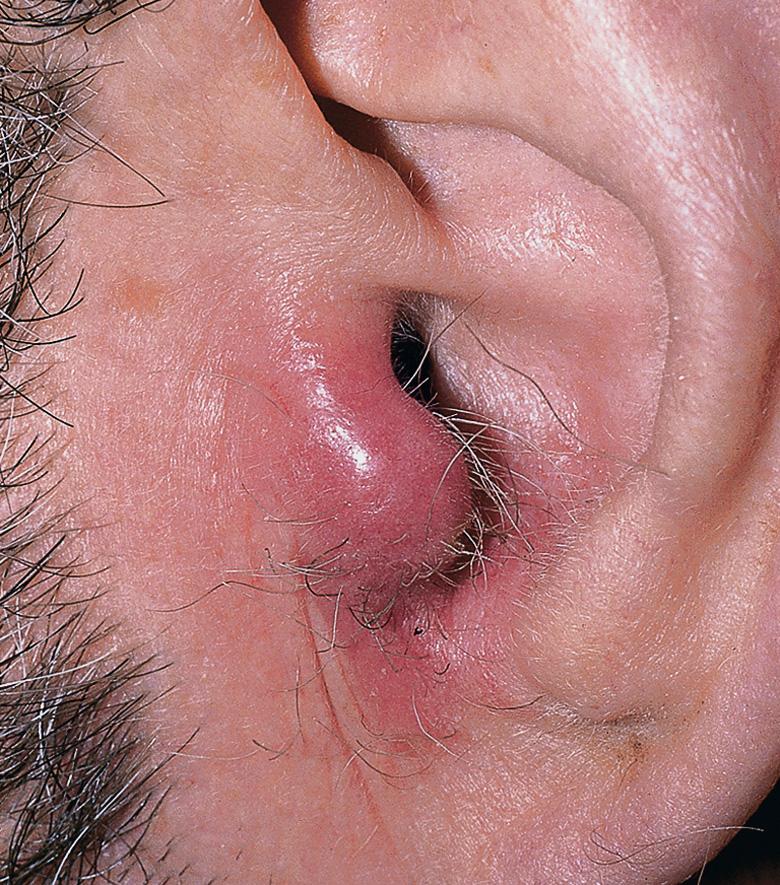 Fig. 48.2, Tophaceous gout of the tragus.