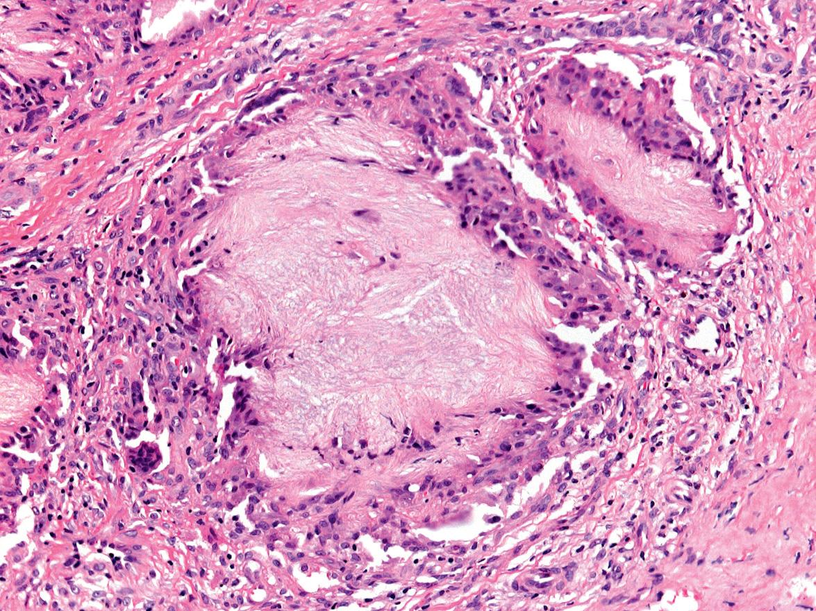 Fig. 48.3, Tophaceous gout – histologic features.