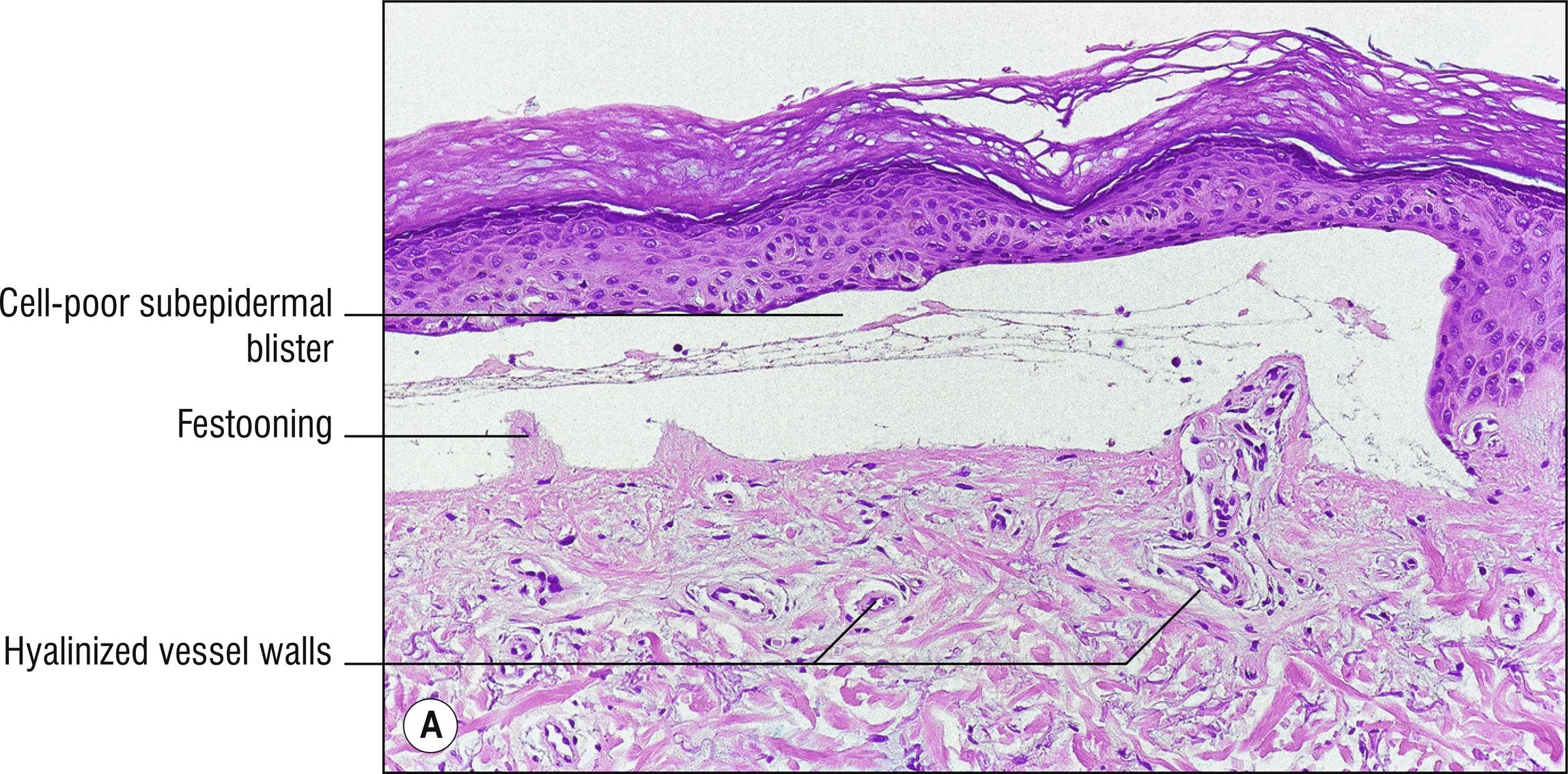 Fig. 8.1, A Porphyria cutanea tarda (low mag.).