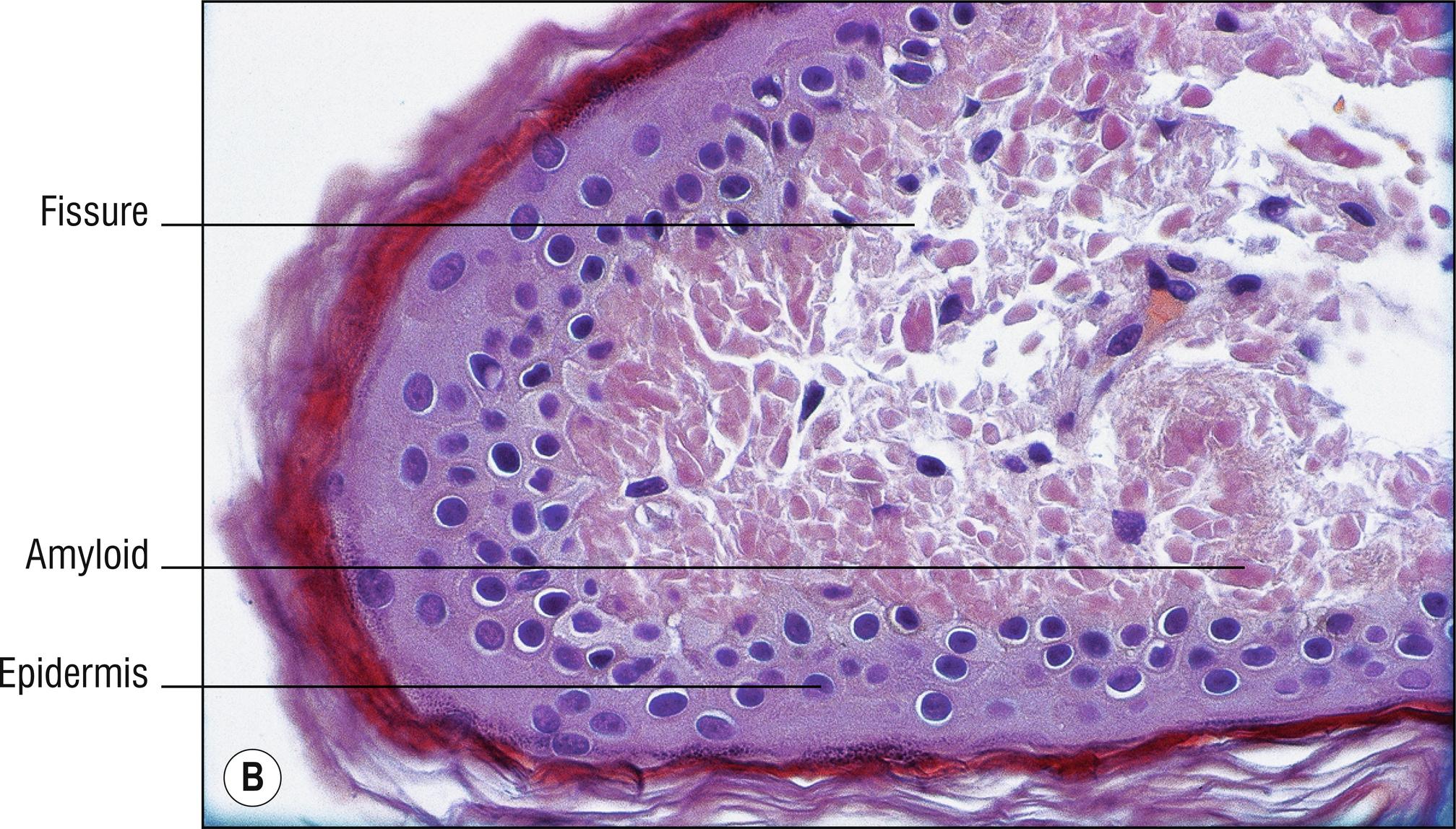 Fig. 8.4, B Primary amyloidosis (Congo red stain).
