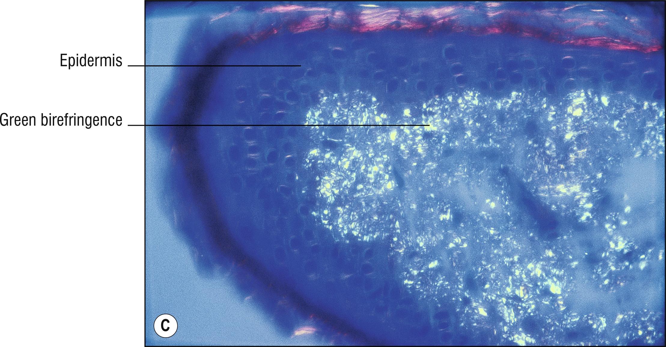 Fig. 8.4, C Primary amyloidosis (Congo red stain, polarized).